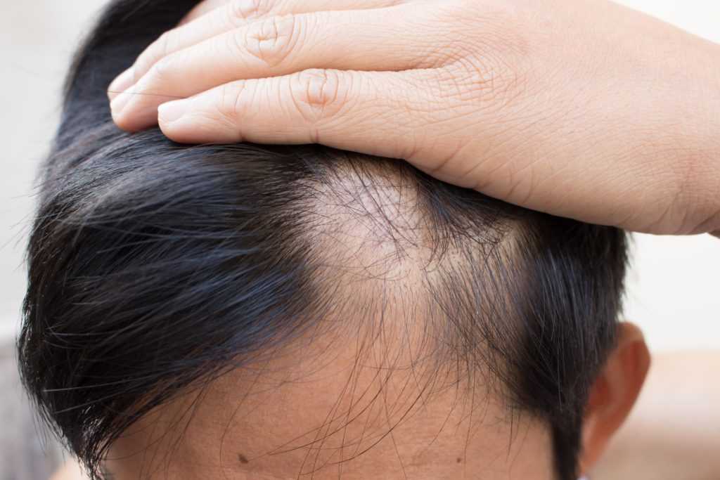 Проблемы с волосами из-за стрессов, неврозов и депрессии