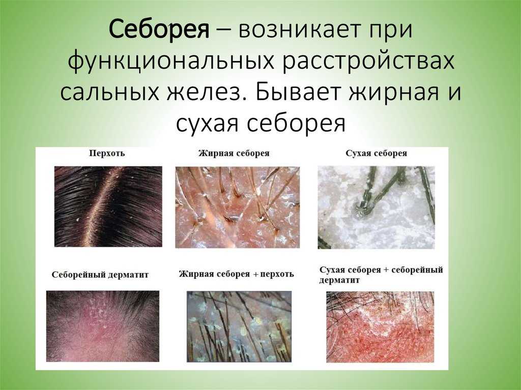 Причины неприятного запаха от кожи головы