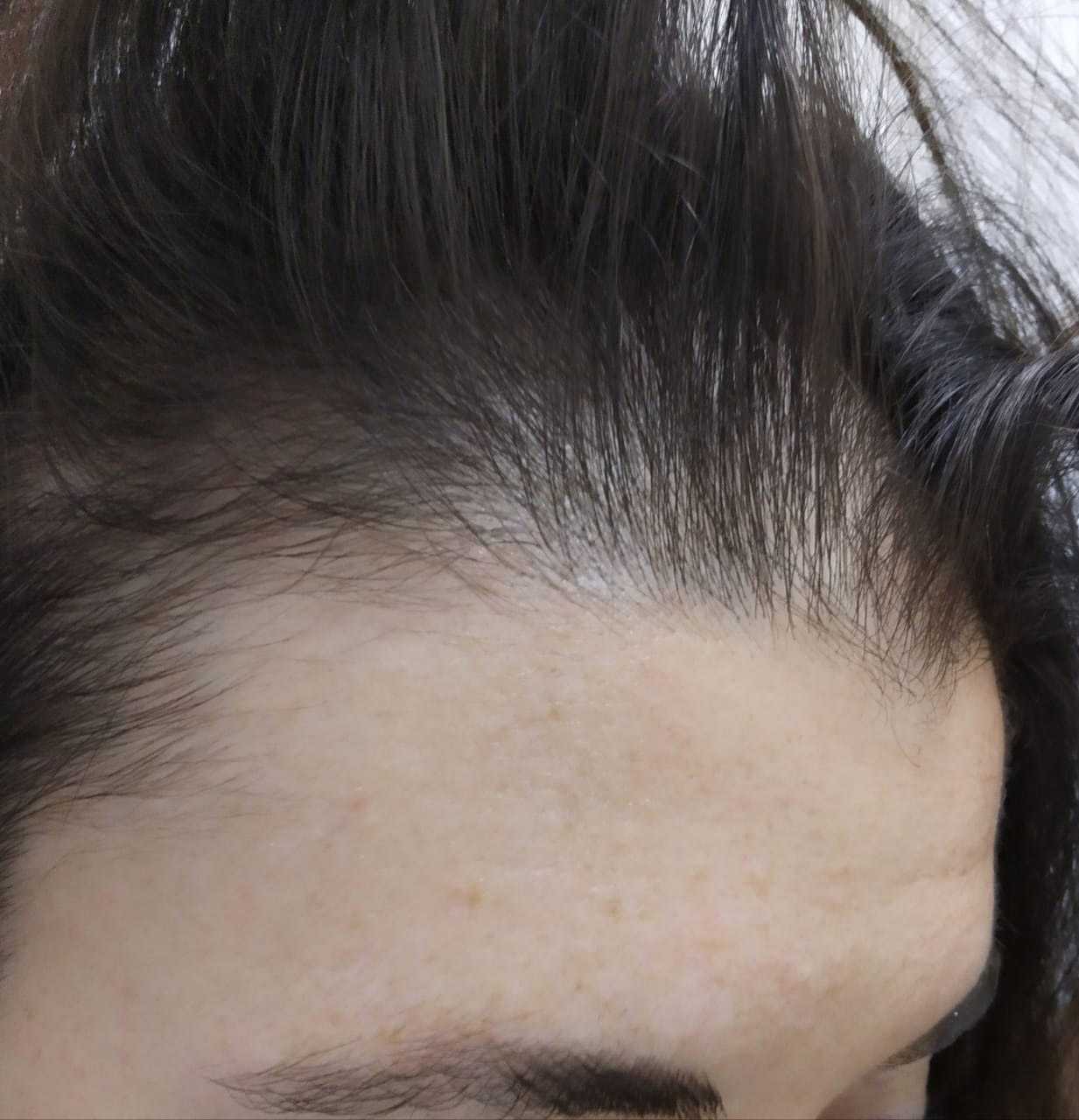 Причины очагового выпадения волос у мужчин и женщин, методы лечения заболевания
