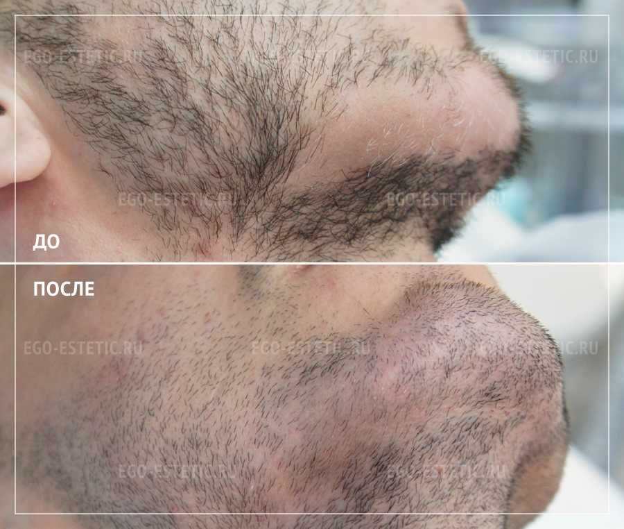 Алопеция бороды у мужчин — облысение и проплешины на подбородке