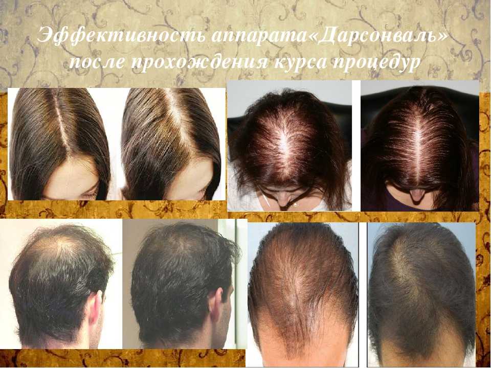 Дарсонваль для волос: противопоказания и меры предосторожности