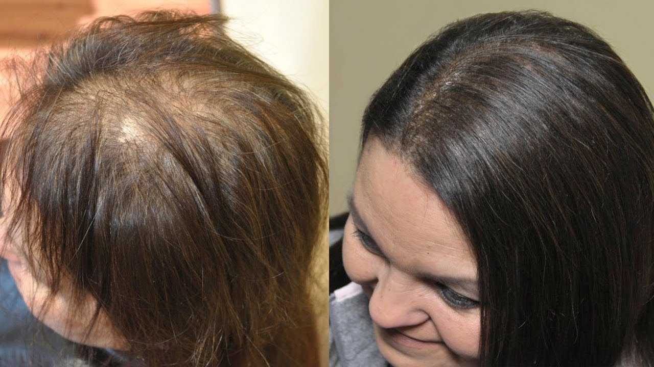 Восстановление волос после их выпадения