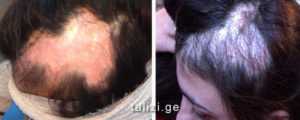 Всегда ли выпадают волосы после химиотерапии, как можно ли это предотвратить