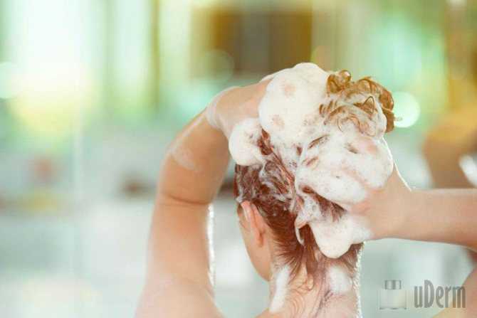 Особенности псориаза на коже головы - как вылечить?