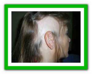 Всегда ли выпадают волосы после химиотерапии, как можно ли это предотвратить