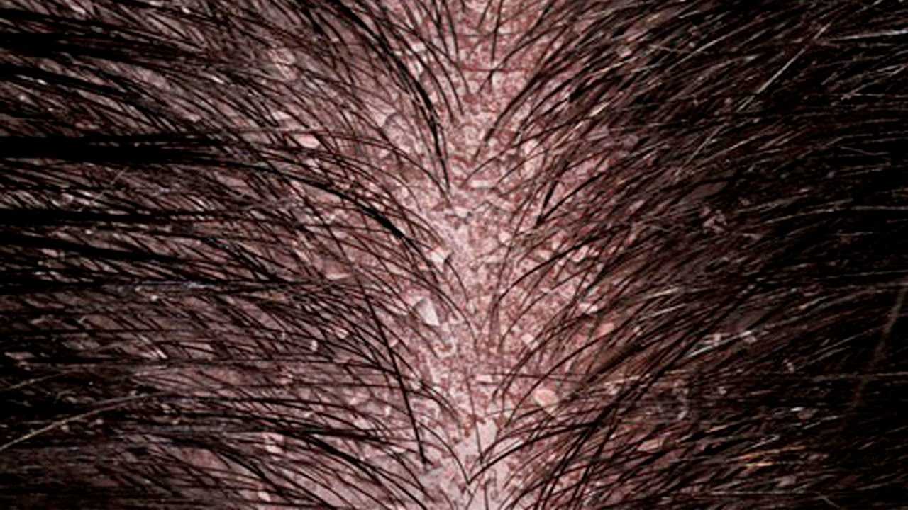 Болячки на голове в волосах. фото, причины и лечение в домашних условиях