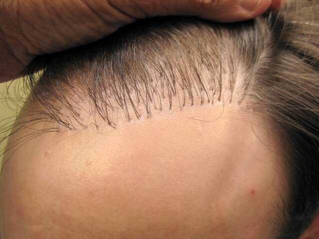 Почему у мужчин не растут волосы на лбу