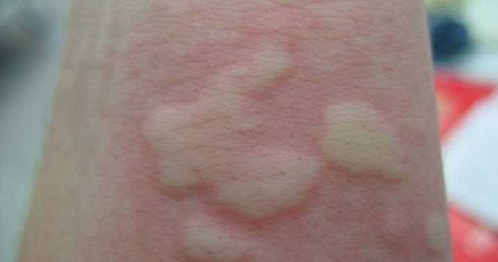 Сыпь на спине – что может быть причиной, и можно ли от нее избавиться?