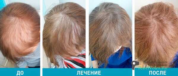 Генеролон для роста волос: как работает этот спрей для роста волос
