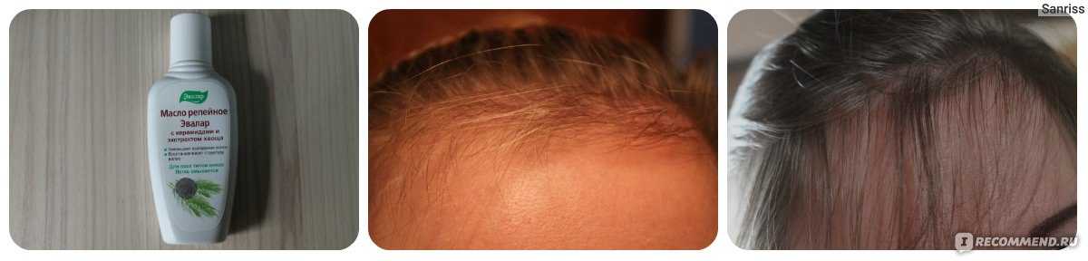 Эсвицин для роста волос: как работает и есть ли эффект от применения