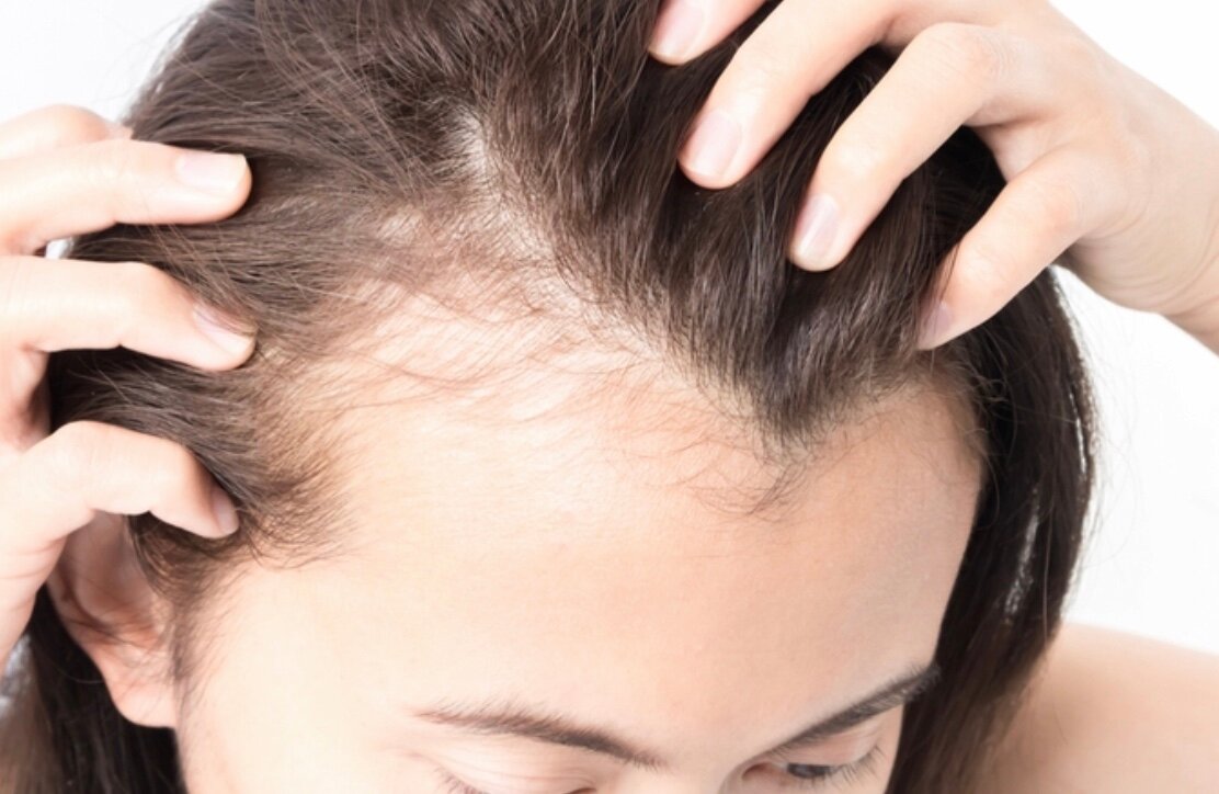 Не все потеряно: как остановить выпадение волос у мужчин