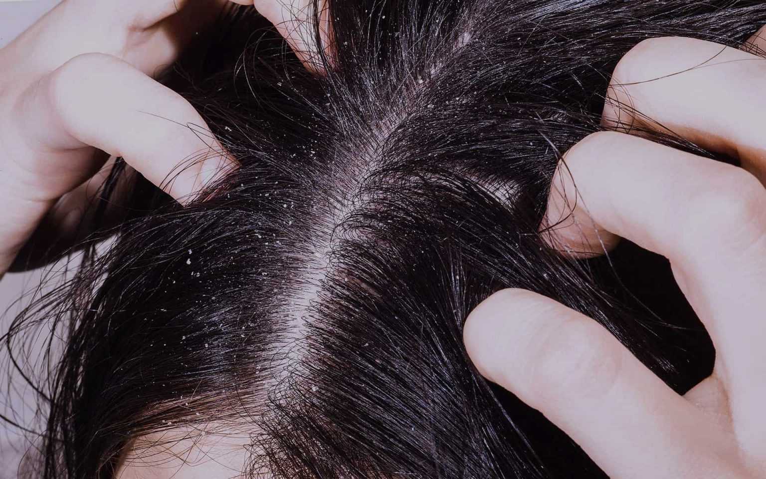 Что делать если после покраски волос чешется кожа головы