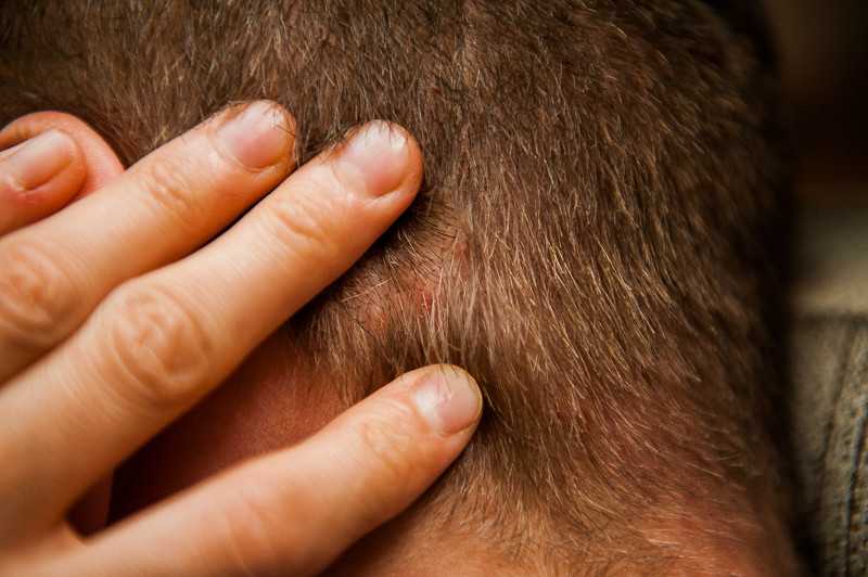 Болячки на голове: коросты в волосах, причины, почему чешется голова и появляются мокнущие болячки и перхоть, лечение у взрослых и детей, фото