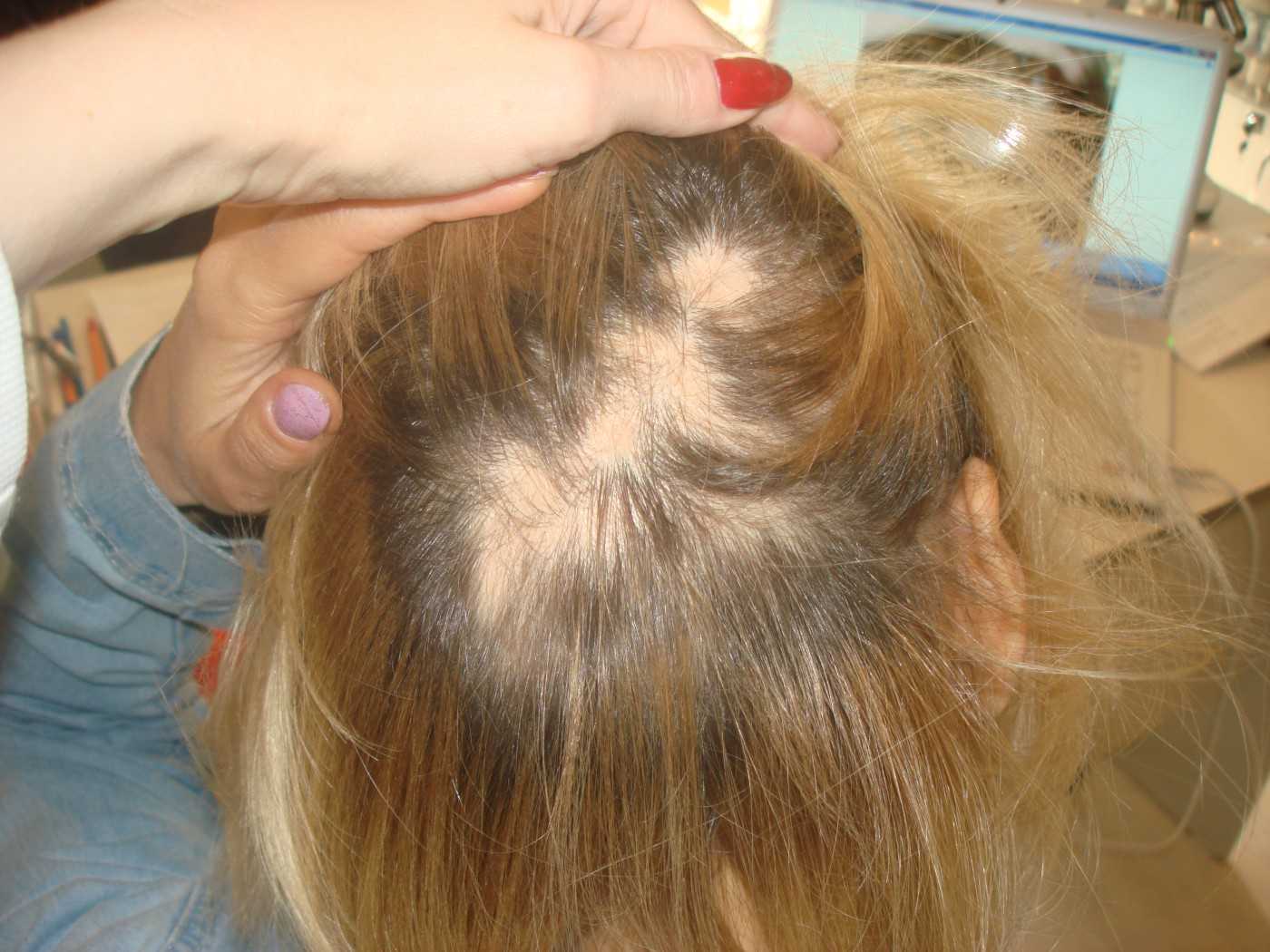 Выпадение волос после общего наркоза: профилактика и решение проблемы