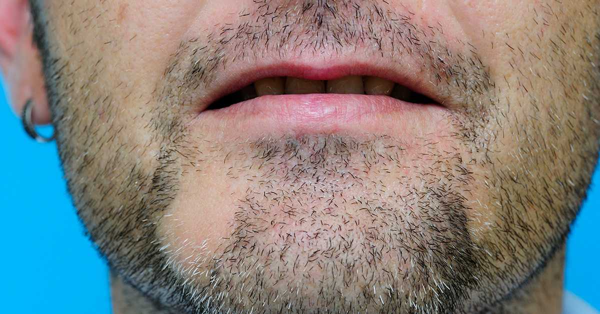 Алопеция бороды у мужчин: причины и лечение