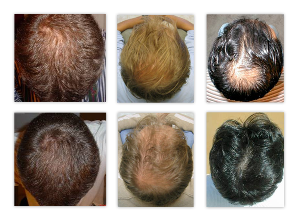 Популярные средства от выпадения волос: выбираем самое эффективное