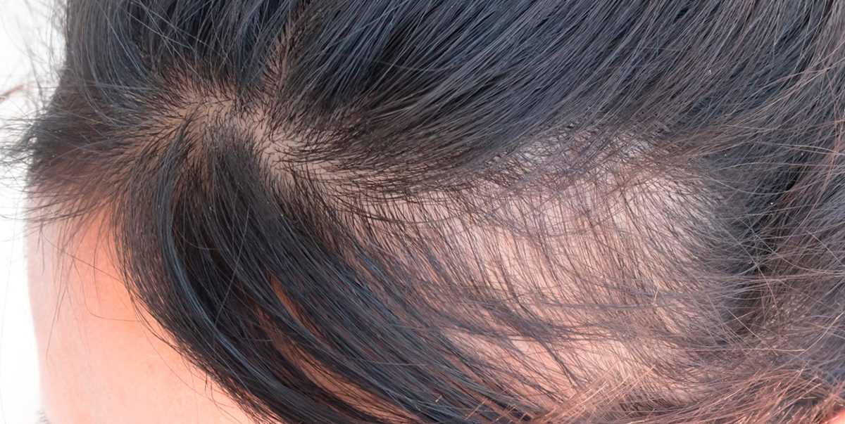 Выпадают волосы после родов: что делать, как остановить, почему сильно лезут локоны при грудном вскармливании, причины и лечение, витамины (элевит и другие средства), отзывы