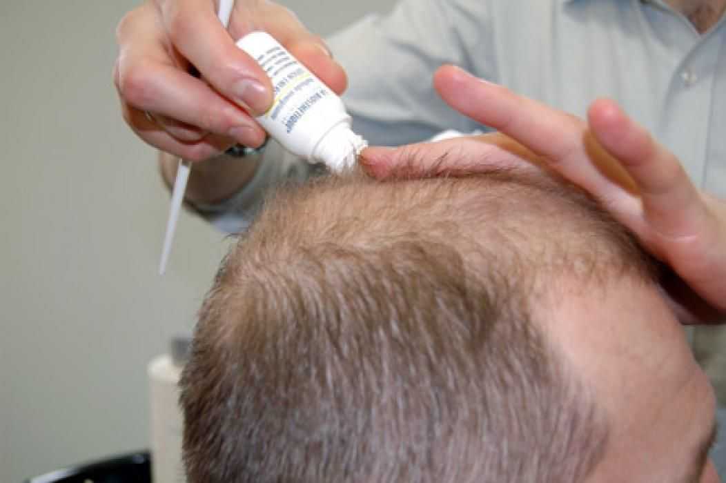 Препараты с миноксидилом для волос: отзывы, инструкция, результаты. миноксидил миноксидил побочные эффекты отзывы