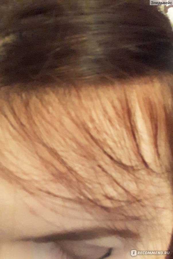 Как восстановить густоту волос после выпадения