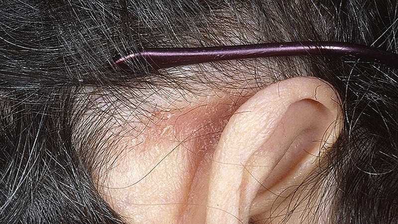 Почему шелушатся уши: причины и методы лечения