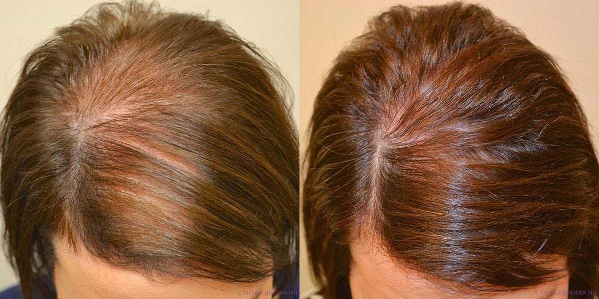 Алопеция: причины и лечение выпадения волос