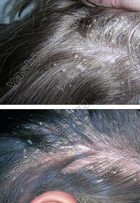Что делать, если после окрашивания волос чешется и болит кожа головы? лечим ожог