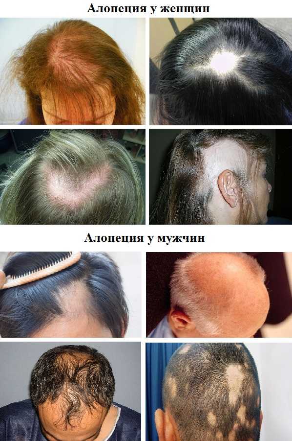 Как остановить выпадение волос у женщины народными средствами?