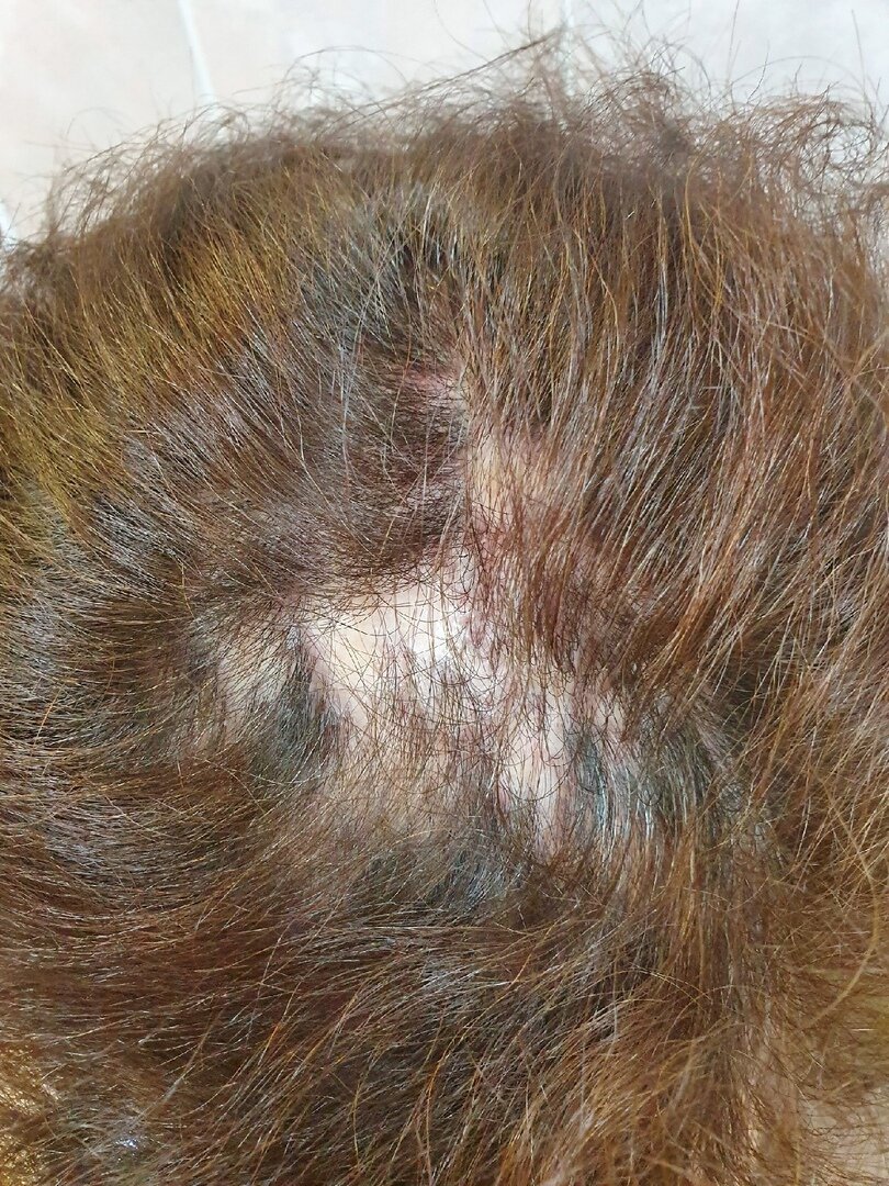 Причину выпадения волос после 40. Гормональное выпадение волос.