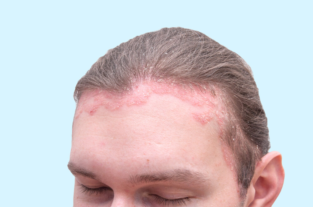 Все, что вы не знали о себорейном дерматите на коже головы
