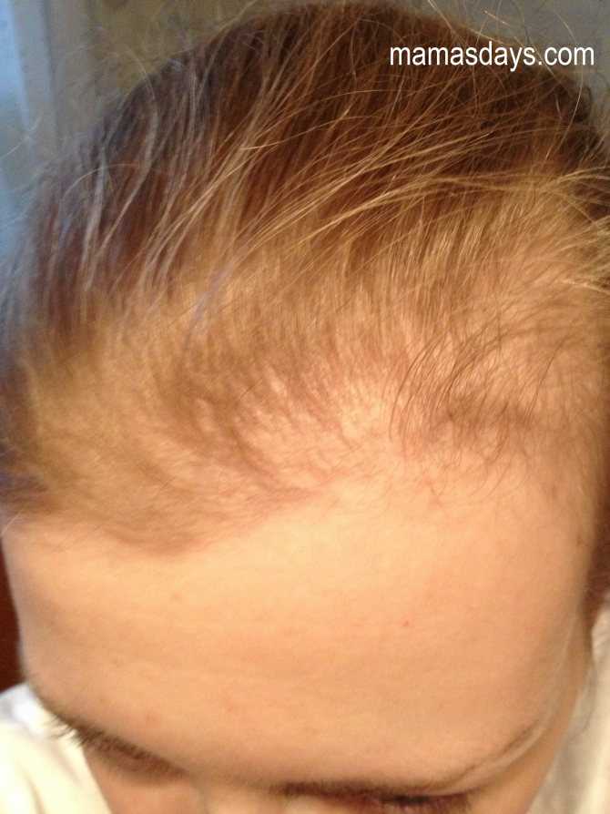 Выпадают волосы после родов: причины, что делать?