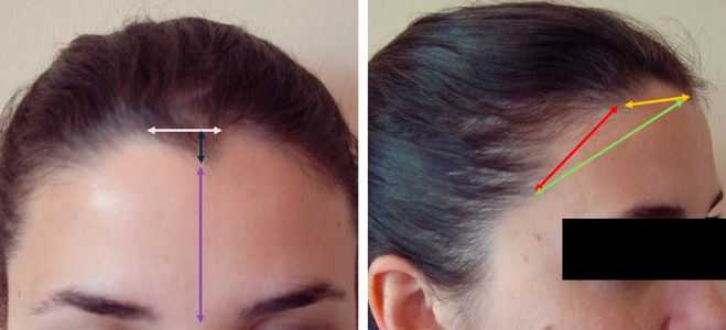 Линия роста волос на лбу: что это такое, как производится коррекция неровной линии роста волос