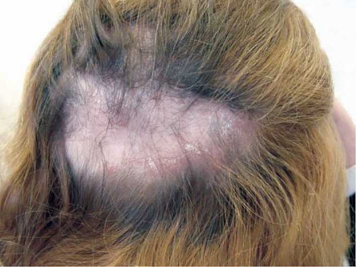 Алопеция: причины выпадения волос, лечение в зависимости от вида заболевания