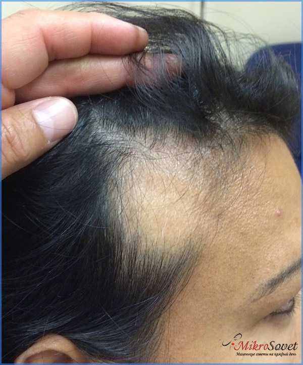 Выпадение волос у женщин и мужчин: причины, лечение, средства