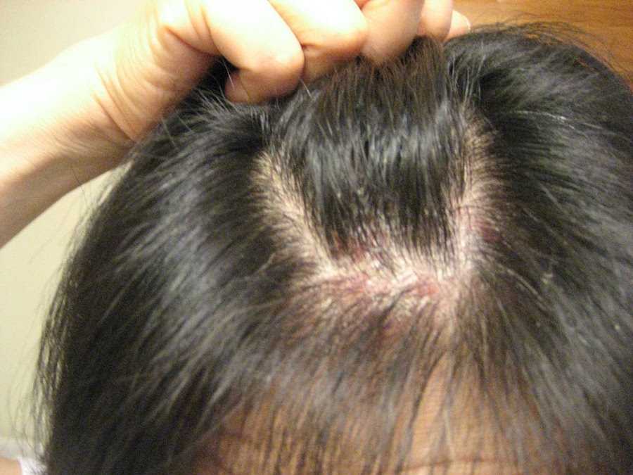 Что делать, если после окрашивания волос чешется и болит кожа головы? лечим ожог