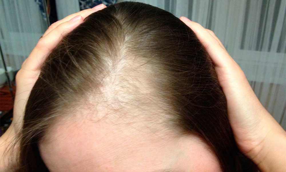 Почему выпадают волосы у женщин? [7 причин]