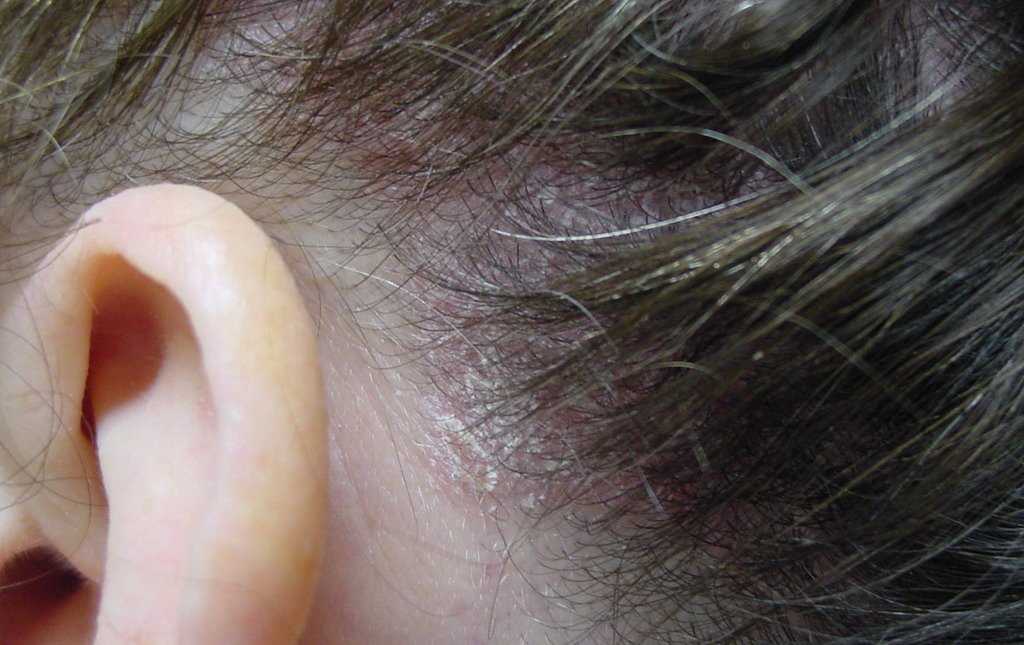 Чем лечить шелушение ушей. шелушится кожа в ухе: основные причины и методы лечения