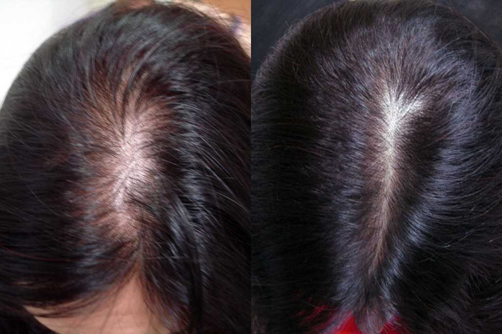 Противопоказания проведения процедур мезотерапии для волос