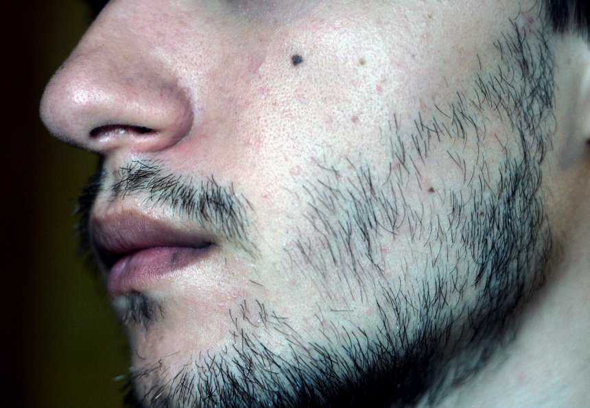 Будет ли расти борода на шраме
