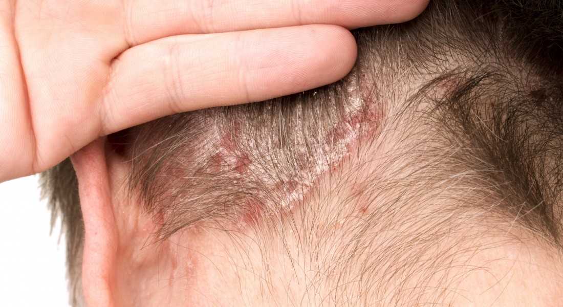 Перхоть на бровях: почему шелушится кожа и как от этого избавиться, причины и лечение себорейного дерматита и грибка на бровях