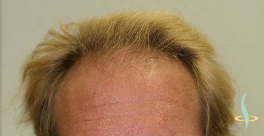 Лазерная коррекция линии роста волос