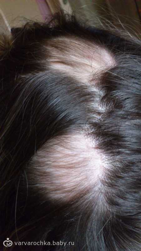 Что делать при выпадении волос от стресса?