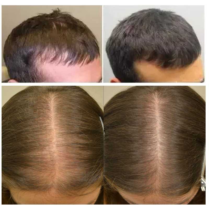 Реальная помощь от облысения — генеролон спрей для волос