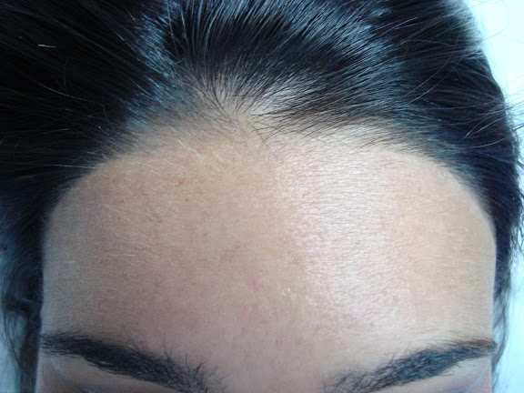 Линия роста волос на лбу: что это такое, как производится коррекция неровной линии роста волос