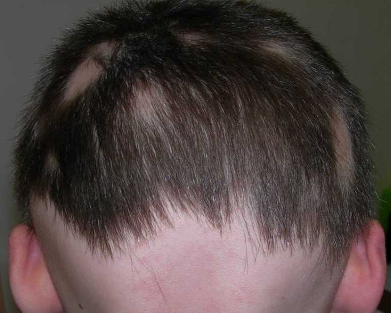 Лишай волосистой части головы — фото с описанием симптомов, лечение, причины