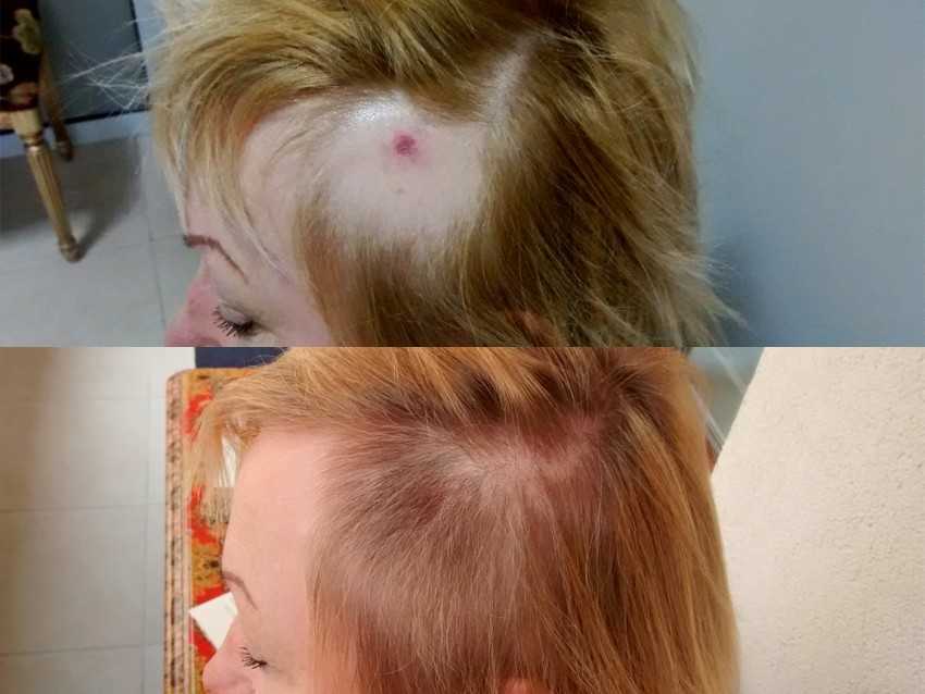 Выпадение волос от краски — лечение волос после окрашивания