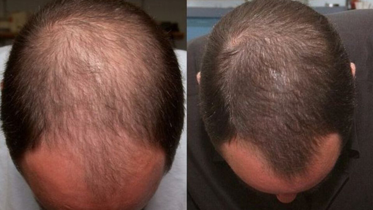 Топ-10 медицинских средств от выпадения волос у мужчин