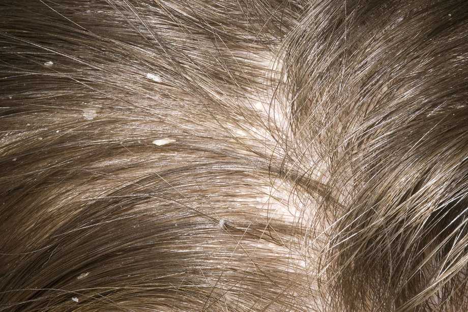 Распространенные причины шелушения кожи головы