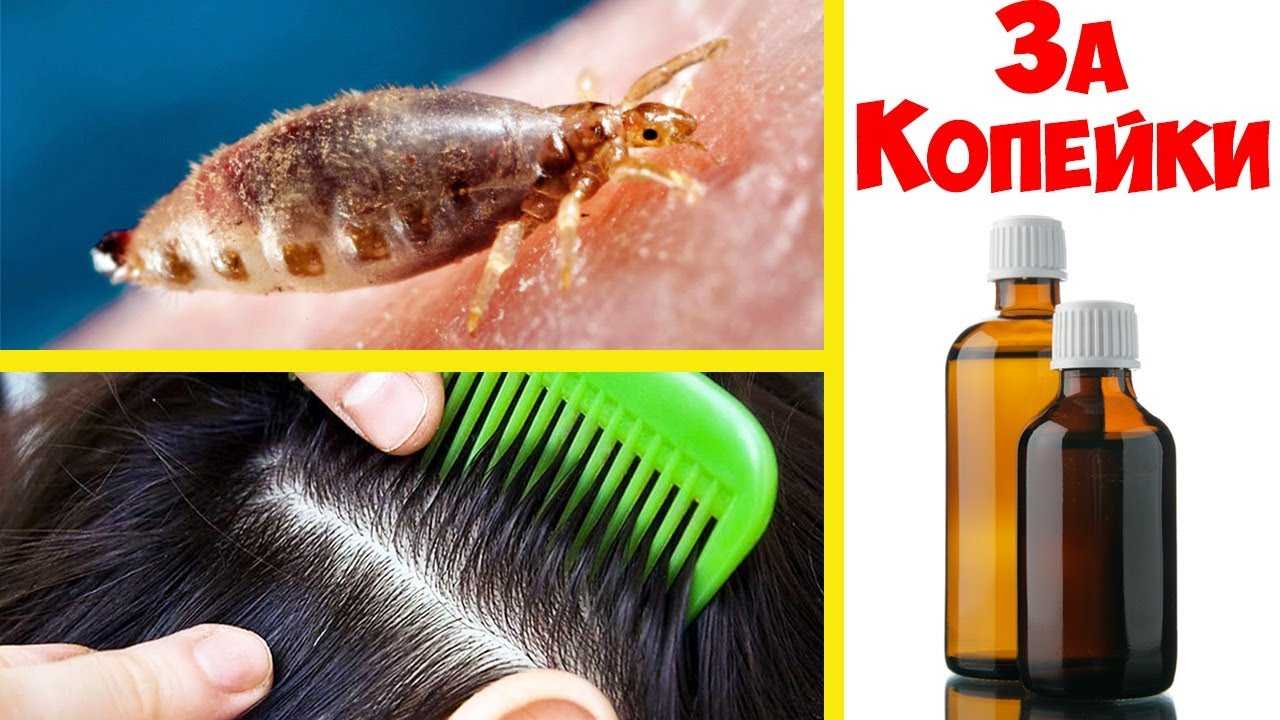 Эффективный способ борьбы с паразитами: как правильно вычесать гнид после обработки волос?