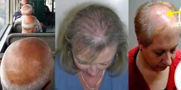 Выпадают волосы после химиотерапии что делать