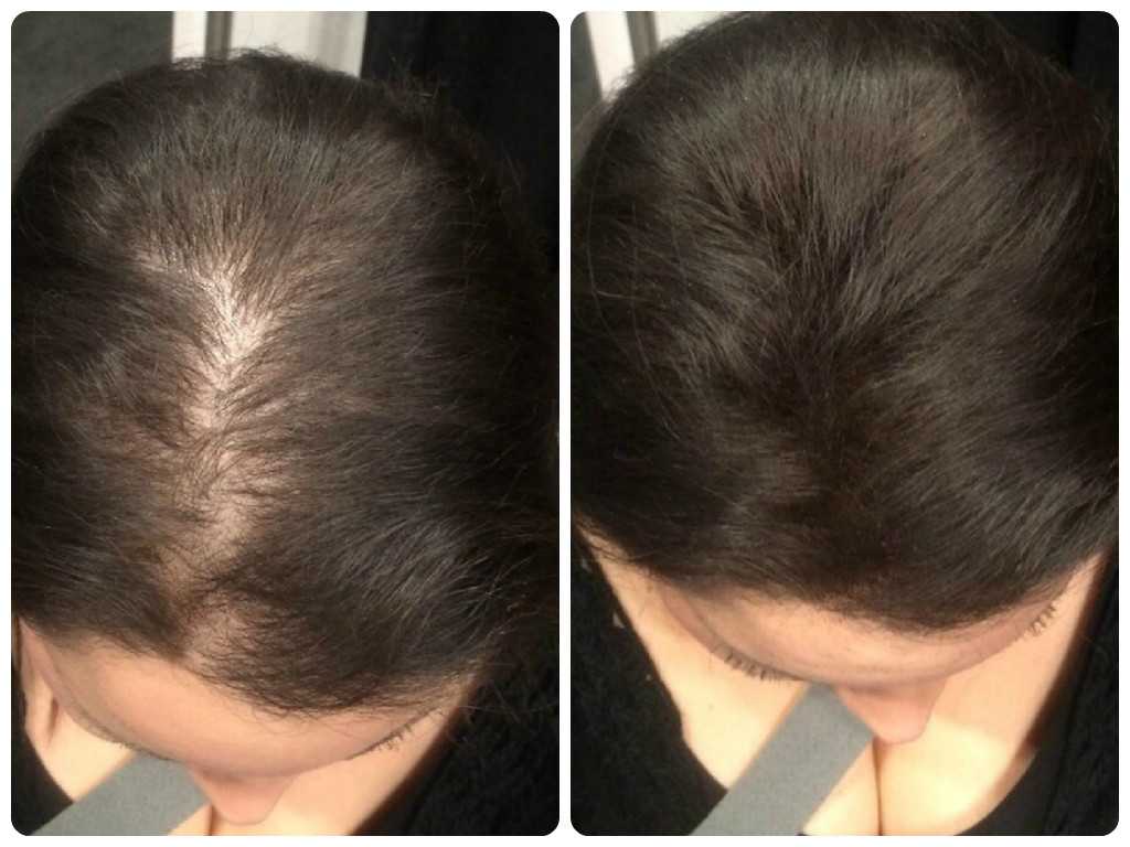 Как восстановить густоту волос после выпадения